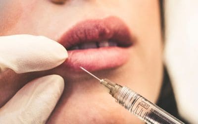 No, Your Lip Filler Hasn’t Migrated — It Was Injected Incorrectly