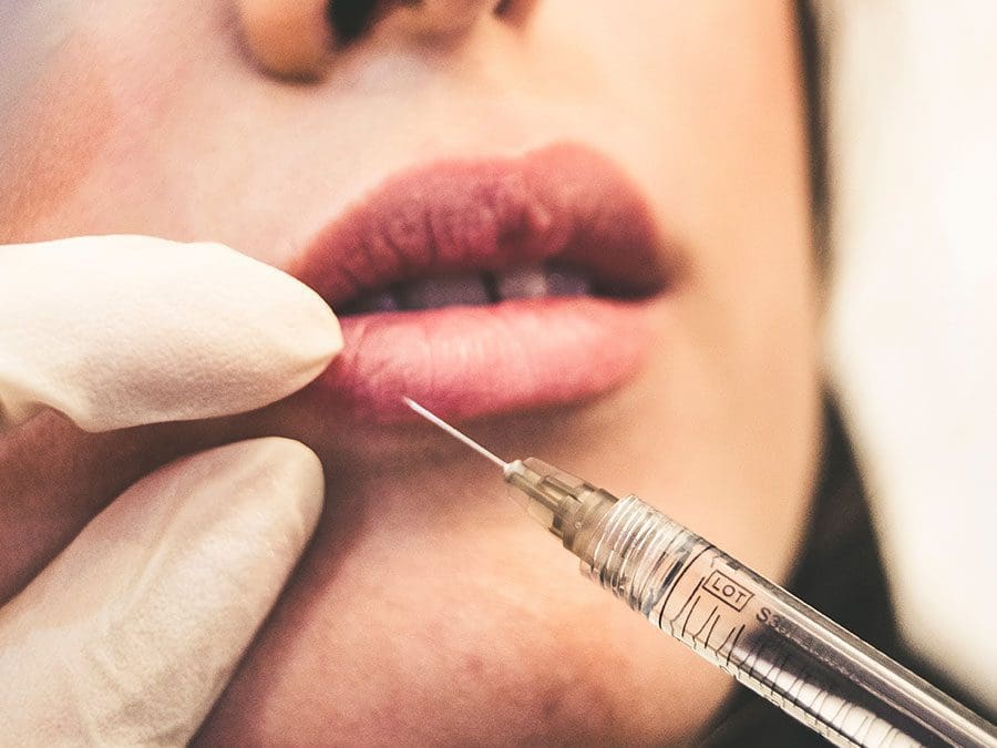 No, Your Lip Filler Hasn’t Migrated — It Was Injected Incorrectly